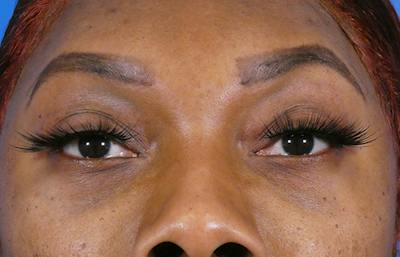 Under Eye Filler Before & After Gallery - Patient 372285 - Image 2