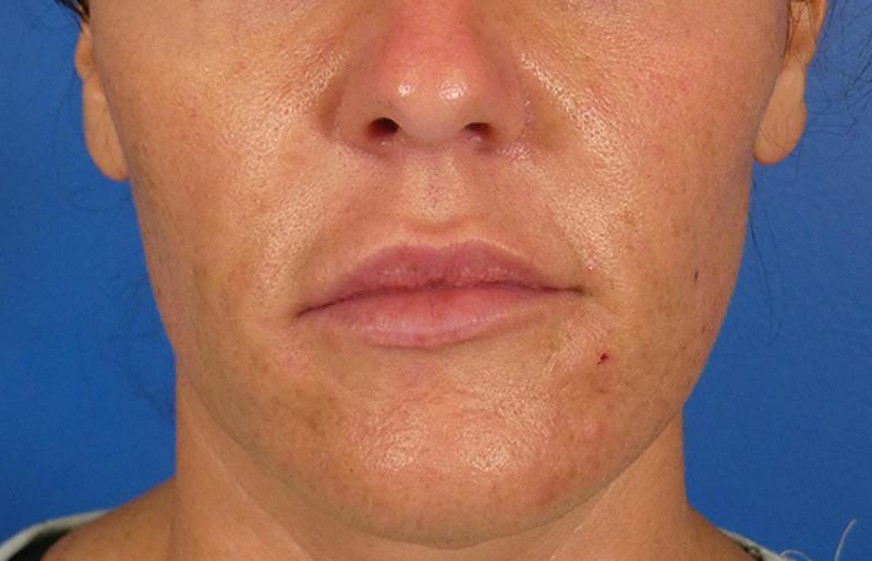 Injectables Face Before & After Gallery - Patient 145442 - Image 1