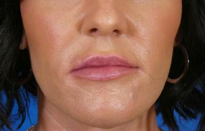 Injectables Face Before & After Gallery - Patient 145442 - Image 2