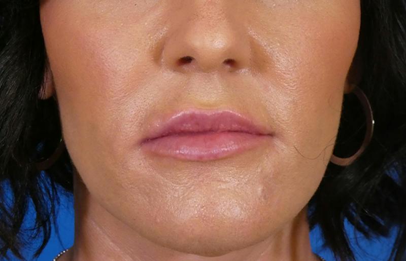 Injectables Face Before & After Gallery - Patient 145442 - Image 2