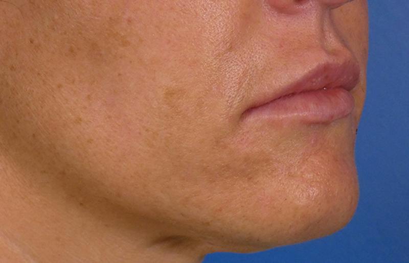 Injectables Face Before & After Gallery - Patient 145442 - Image 3