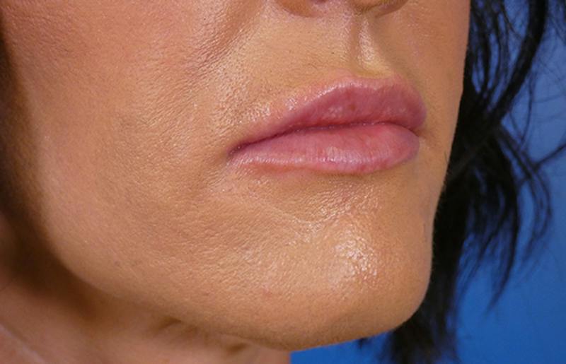 Injectables Face Before & After Gallery - Patient 145442 - Image 4