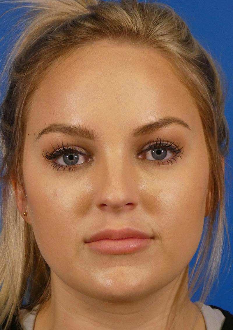 Injectables Face Before & After Gallery - Patient 323131 - Image 1