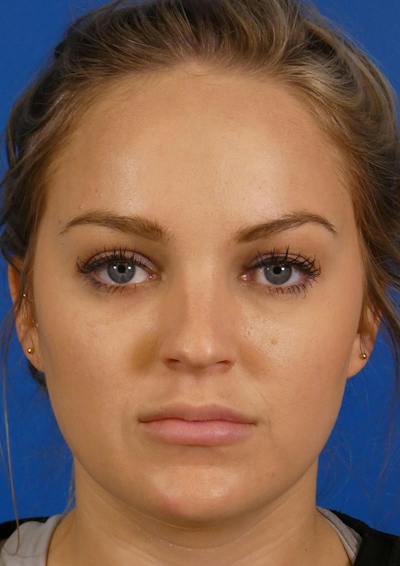 Injectables Face Before & After Gallery - Patient 323131 - Image 2