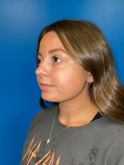 Injectables Face Before & After Gallery - Patient 156740 - Image 1