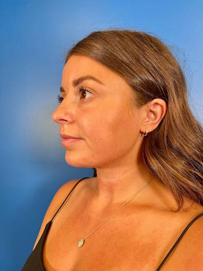 Injectables Face Before & After Gallery - Patient 156740 - Image 2