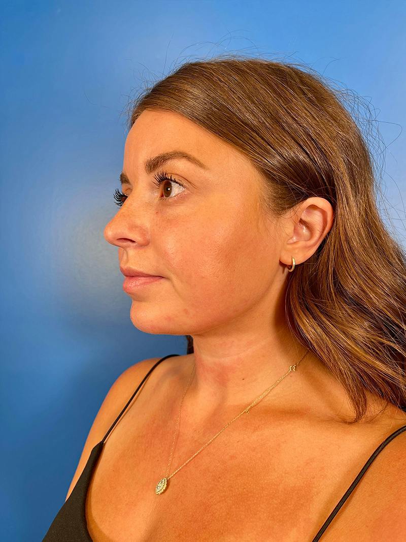 Injectables Face Before & After Gallery - Patient 156740 - Image 2