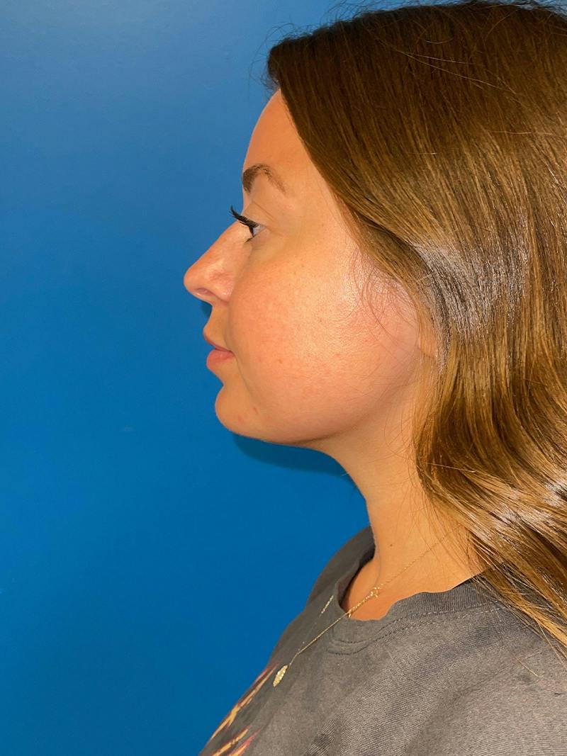 Injectables Face Before & After Gallery - Patient 156740 - Image 3