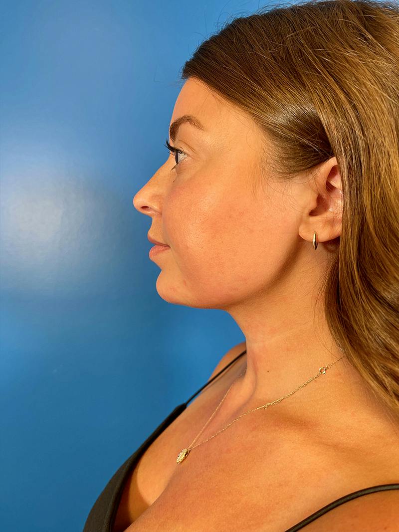 Injectables Face Before & After Gallery - Patient 156740 - Image 4