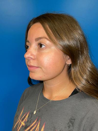 Injectables Face Before & After Gallery - Patient 859833 - Image 1