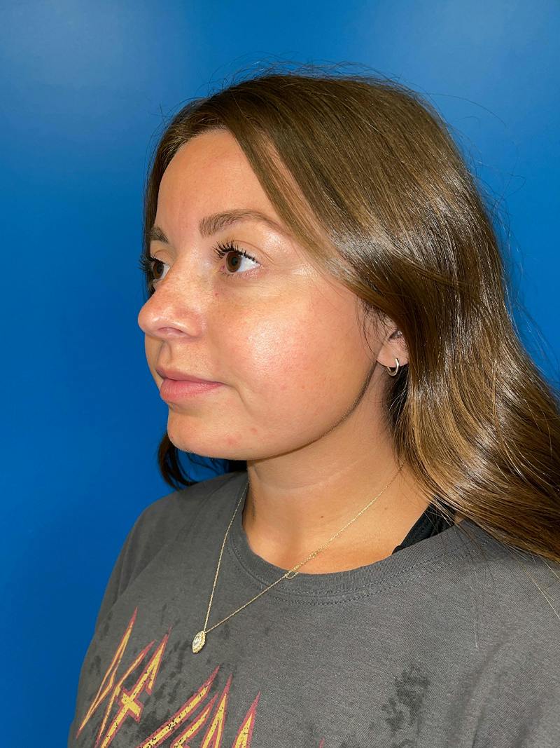 Injectables Face Before & After Gallery - Patient 859833 - Image 1