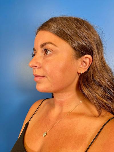 Injectables Face Before & After Gallery - Patient 859833 - Image 2