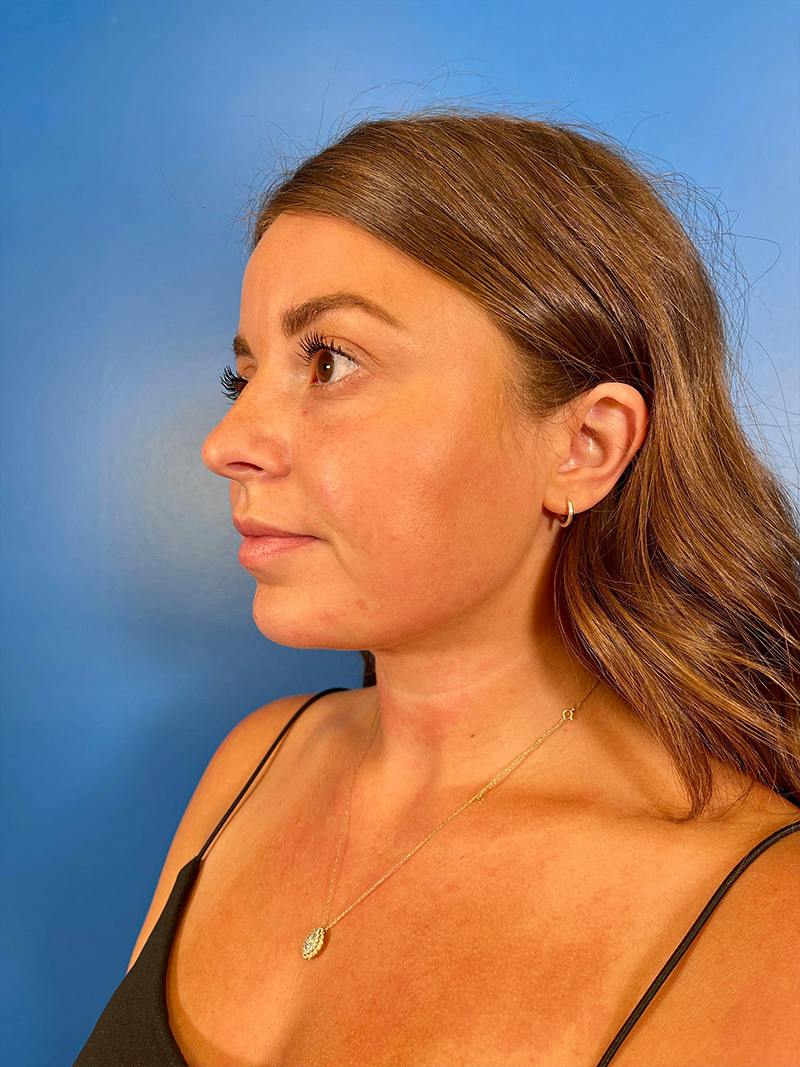 Injectables Face Before & After Gallery - Patient 859833 - Image 2
