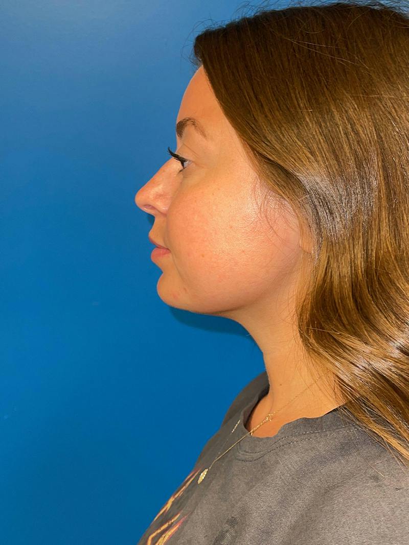 Injectables Face Before & After Gallery - Patient 859833 - Image 3