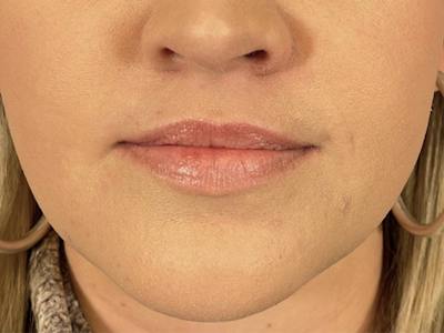 Lip Filler Before & After Gallery - Patient 351176 - Image 1