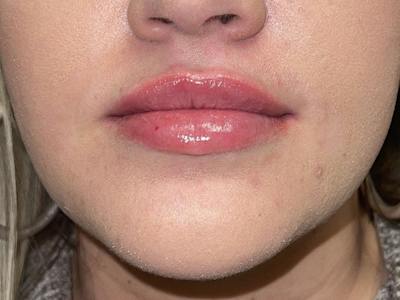 Lip Filler Before & After Gallery - Patient 351176 - Image 2