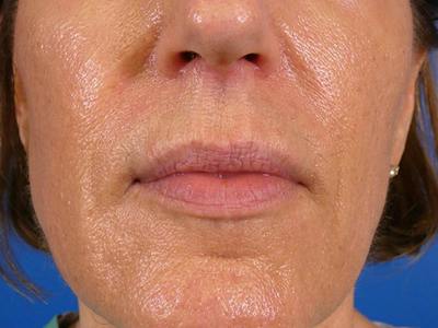 Lip Filler Before & After Gallery - Patient 369398 - Image 1