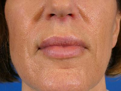 Lip Filler Before & After Gallery - Patient 369398 - Image 2