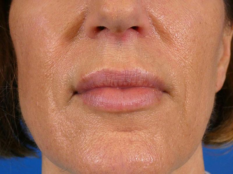 Lip Filler Before & After Gallery - Patient 369398 - Image 2
