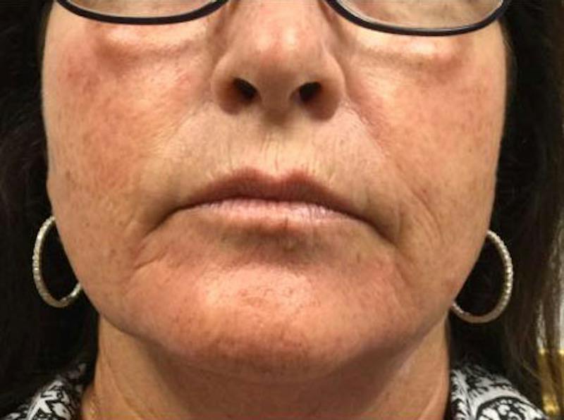 Lip Filler Before & After Gallery - Patient 403931 - Image 1