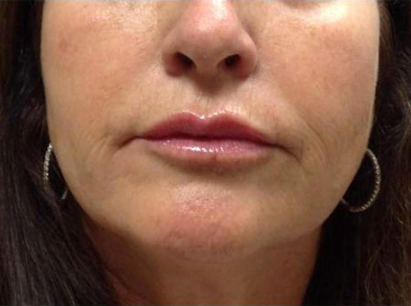 Lip Filler Before & After Gallery - Patient 403931 - Image 2
