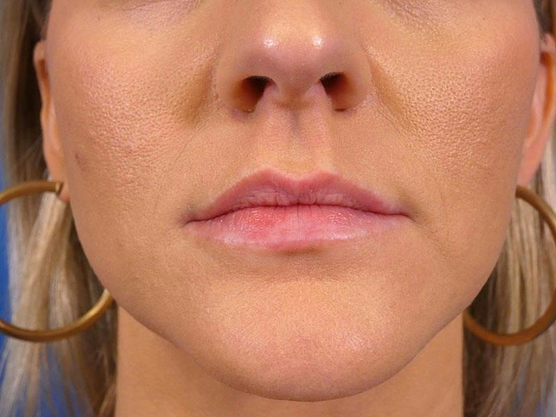Lip Filler Before & After Gallery - Patient 417592 - Image 1