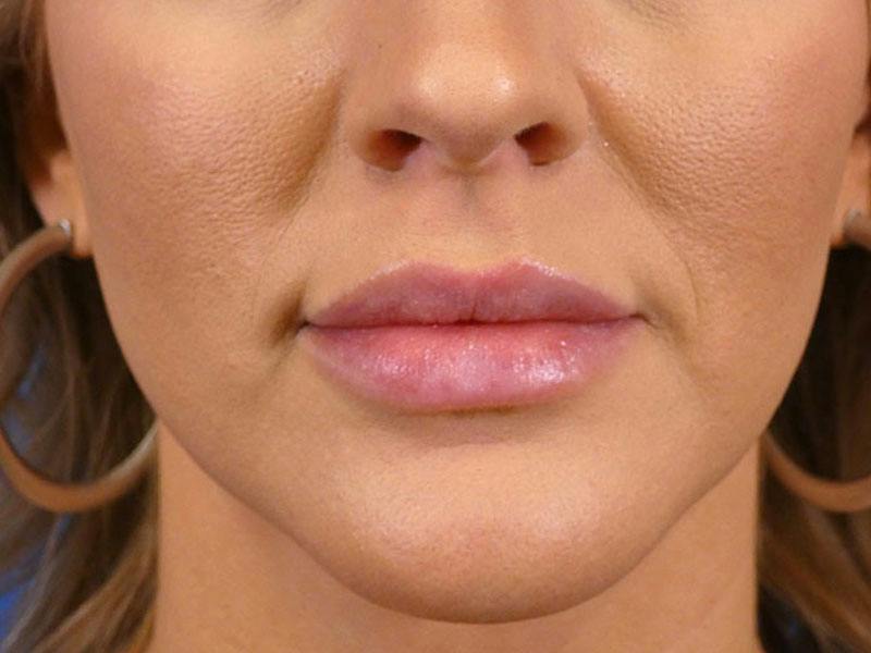 Lip Filler Before & After Gallery - Patient 417592 - Image 2
