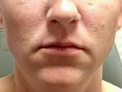 Lip Filler Before & After Gallery - Patient 241068 - Image 1