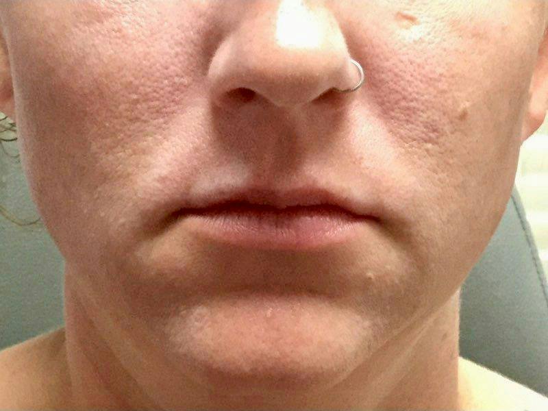 Lip Filler Before & After Gallery - Patient 241068 - Image 1