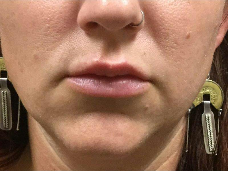 Lip Filler Before & After Gallery - Patient 241068 - Image 2