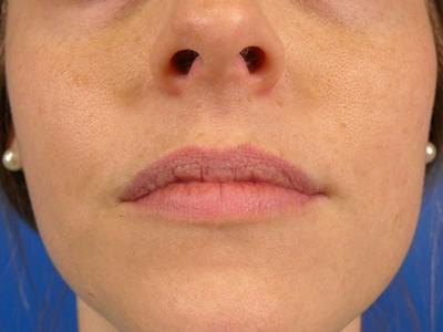 Lip Filler Before & After Gallery - Patient 339907 - Image 1