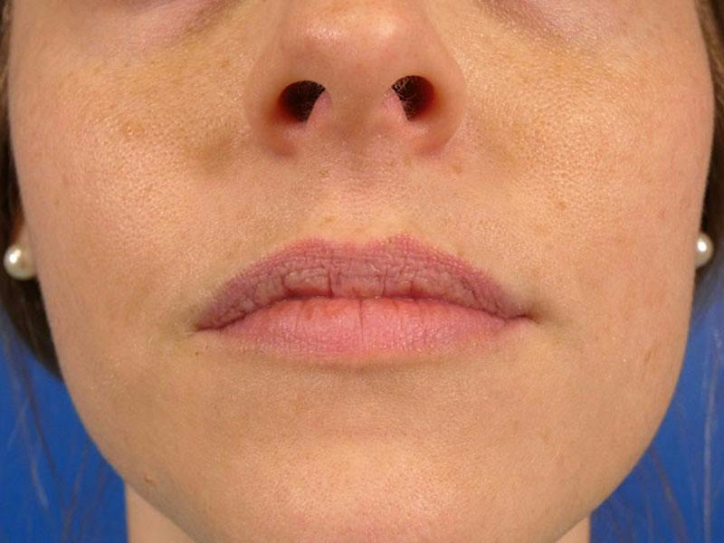 Lip Filler Before & After Gallery - Patient 339907 - Image 1