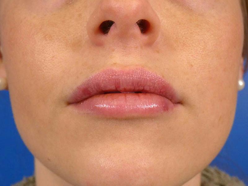 Lip Filler Before & After Gallery - Patient 339907 - Image 2