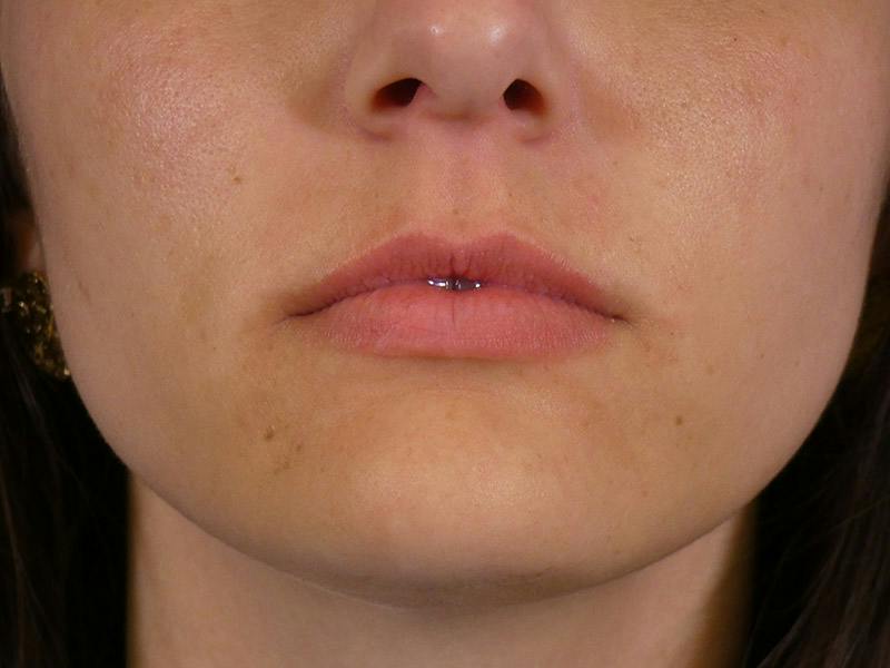 Lip Filler Before & After Gallery - Patient 108985 - Image 1