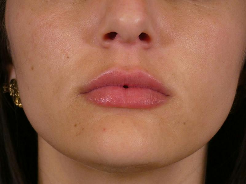 Lip Filler Before & After Gallery - Patient 108985 - Image 2
