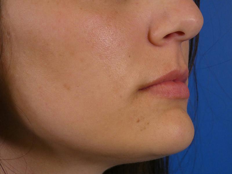 Lip Filler Before & After Gallery - Patient 108985 - Image 3