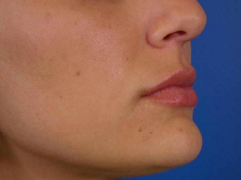 Lip Filler Before & After Gallery - Patient 108985 - Image 4