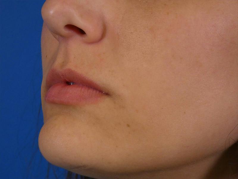 Lip Filler Before & After Gallery - Patient 108985 - Image 5