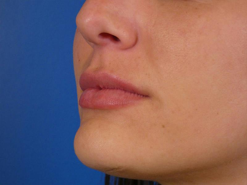 Lip Filler Before & After Gallery - Patient 108985 - Image 6