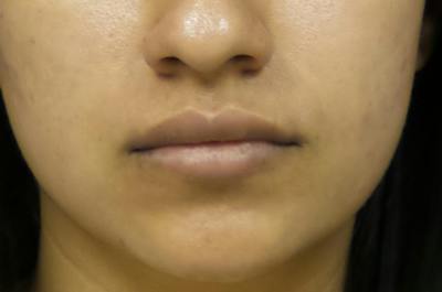 Lip Filler Before & After Gallery - Patient 251958 - Image 1