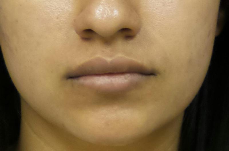 Lip Filler Before & After Gallery - Patient 251958 - Image 1
