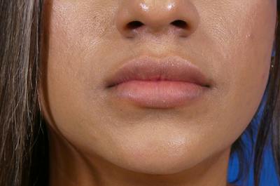 Lip Filler Before & After Gallery - Patient 251958 - Image 2
