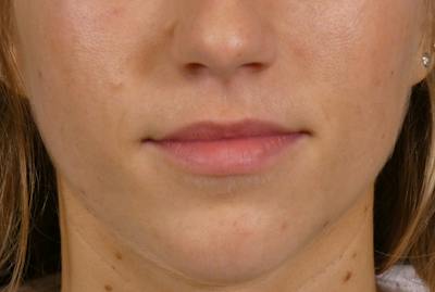 Lip Filler Before & After Gallery - Patient 424628 - Image 1