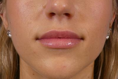 Lip Filler Before & After Gallery - Patient 424628 - Image 2