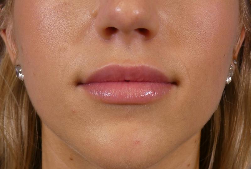 Lip Filler Before & After Gallery - Patient 424628 - Image 2