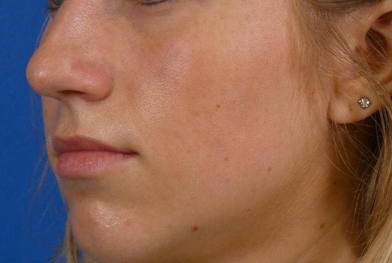 Lip Filler Before & After Gallery - Patient 424628 - Image 3