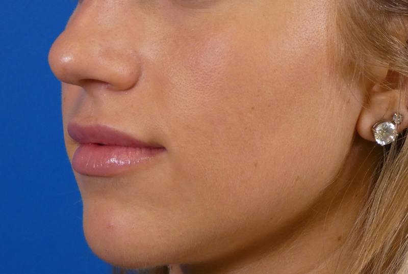 Lip Filler Before & After Gallery - Patient 424628 - Image 4