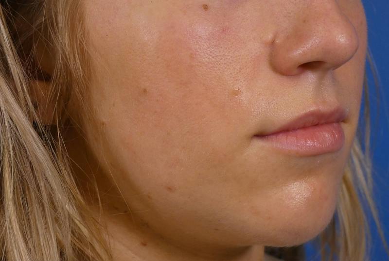 Lip Filler Before & After Gallery - Patient 424628 - Image 5