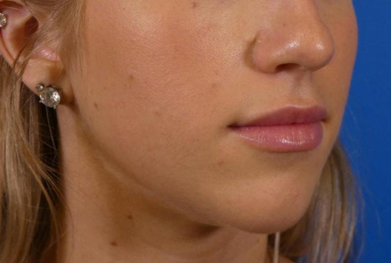 Lip Filler Before & After Gallery - Patient 424628 - Image 6