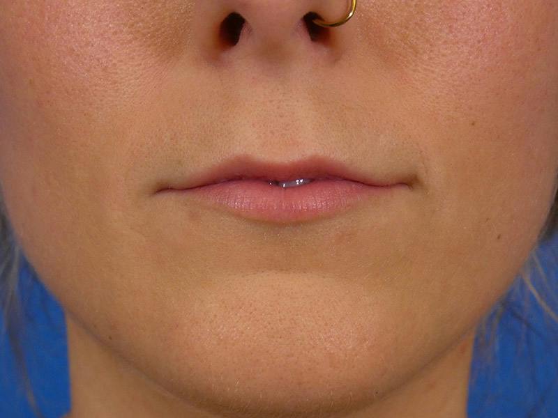 Lip Filler Before & After Gallery - Patient 389038 - Image 1